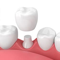 Dental Procedures Mill Creek