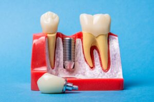 Tooth Crown vs Implant Crown