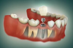 Dental Implants in Mill Creek